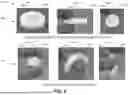 Fig. 11 - ENHANCED OSTEOINDUCTIVE COMPOSITIONS, SYSTEMS, AND METHODS OF MANUFACTURE