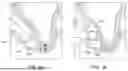 Fig. 02 - EXOSOME BONE GRAFT SYSTEMS, PRODUCTS AND METHODS