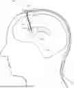 Fig. 01 - IMPLANTABLE INTRAVENTRICULAR SAMPLING AND INFUSION ACCESS DEVICE