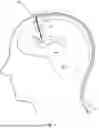 Fig. 02 - IMPLANTABLE INTRAVENTRICULAR SAMPLING AND INFUSION ACCESS DEVICE