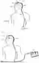 Fig. 04 - IMPLANTABLE INTRAVENTRICULAR SAMPLING AND INFUSION ACCESS DEVICE