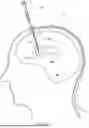 Fig. 05 - IMPLANTABLE INTRAVENTRICULAR SAMPLING AND INFUSION ACCESS DEVICE