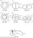 Fig. 08 - IMPLANTABLE INTRAVENTRICULAR SAMPLING AND INFUSION ACCESS DEVICE