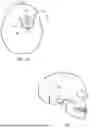 Fig. 09 - IMPLANTABLE INTRAVENTRICULAR SAMPLING AND INFUSION ACCESS DEVICE