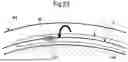 Fig. 24 - SURGICAL METHOD FOR DELIVERING DRUG SOLUTION TO MYOCARDIUM