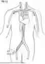 Fig. 10 - INTRODUCER SHEATH