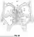 Fig. 13 - SUBMUCOSAL BIORESORBABLE DRUG ELUTING PLATFORM