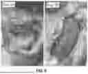 Fig. 19 - SUBMUCOSAL BIORESORBABLE DRUG ELUTING PLATFORM