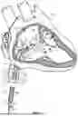 Fig. 02 - DELIVERY AND RETRIEVAL SYSTEM FOR MEDICAL DEVICE