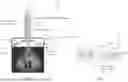 Fig. 06 - SIMULTANEOUS ULTRASONIC IMAGING AND LOW INTENSITY FOCUSED ULTRASOUND THERAPY