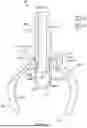 Fig. 11 - CONDUIT ACCESS ADAPTOR DEVICES AND METHODS