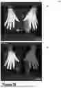 Fig. 11 - Systems and Methods for Quantifying Skin Pigmentation Conditions