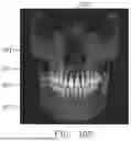 Fig. 15 - METHOD FOR GENERATING DENTAL REGISTRATION DATA