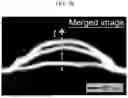 Fig. 11 - Non-Destructive Pressure-Assisted Tissue Stiffness Measurement Apparatus