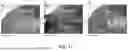 Fig. 72 - Non-Destructive Pressure-Assisted Tissue Stiffness Measurement Apparatus
