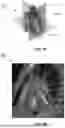 Fig. 03 - AUTONOMOUS SEGMENTATION OF CONTRAST FILLED CORONARY ARTERY VESSELS ON COMPUTED TOMOGRAPHY IMAGES