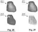 Fig. 05 - AUTONOMOUS SEGMENTATION OF CONTRAST FILLED CORONARY ARTERY VESSELS ON COMPUTED TOMOGRAPHY IMAGES