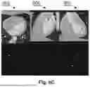 Fig. 09 - AUTONOMOUS SEGMENTATION OF CONTRAST FILLED CORONARY ARTERY VESSELS ON COMPUTED TOMOGRAPHY IMAGES