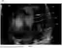 Fig. 04 - METHOD AND SYSTEM FOR ENHANCED VISUALIZATION OF BLOOD FLOW ULTRASOUND IMAGING WITH GLYPHS