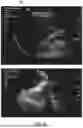 Fig. 04 - SUPPLEMENTED ULTRASOUND