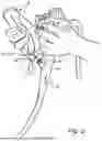 Fig. 03 - BIOPSY INSTRUMENTS AND METHODS