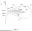 Fig. 04 - LEFT ATRIAL APPENDAGE CLOSURE DEVICE