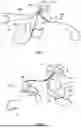 Fig. 03 - Tensionable Knotless Anchors and Methods of Tissue Repair