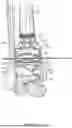 Fig. 16 - GUIDES, INSTRUMENTATION, AND METHODS OF USE AND ASSEMBLY FOR OSTEOTOMY PROCEDURES