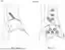 Fig. 36 - GUIDES, INSTRUMENTATION, AND METHODS OF USE AND ASSEMBLY FOR OSTEOTOMY PROCEDURES