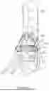Fig. 38 - GUIDES, INSTRUMENTATION, AND METHODS OF USE AND ASSEMBLY FOR OSTEOTOMY PROCEDURES