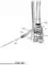 Fig. 63 - GUIDES, INSTRUMENTATION, AND METHODS OF USE AND ASSEMBLY FOR OSTEOTOMY PROCEDURES