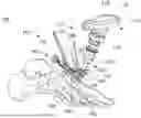 Fig. 01 - INSTRUMENTS AND SURGICAL METHODS FOR BUNION PROCEDURES