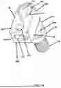 Fig. 11 - ORTHOPEDIC IMPLANT ALTERING APPARATUS AND ASSOCIATED METHOD OF USE