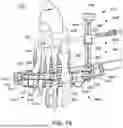 Fig. 11 - INSTRUMENTS AND SURGICAL METHODS FOR BUNION PROCEDURES