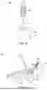 Fig. 22 - INSTRUMENTS AND SURGICAL METHODS FOR BUNION PROCEDURES
