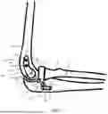 Fig. 02 - SYSTEMS FOR SURGICAL TREATMENT OF THE ELBOW