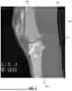 Fig. 05 - AUTOMATED SEGMENTATION FOR ACL REVISION OPERATIVE PLANNING