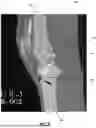 Fig. 06 - AUTOMATED SEGMENTATION FOR ACL REVISION OPERATIVE PLANNING