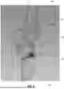Fig. 07 - AUTOMATED SEGMENTATION FOR ACL REVISION OPERATIVE PLANNING