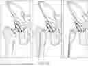 Fig. 35 - METHODS FOR IMPROVED SURGICAL PLANNING USING MACHINE LEARNING AND DEVICES THEREOF