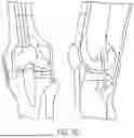 Fig. 44 - METHODS FOR IMPROVED SURGICAL PLANNING USING MACHINE LEARNING AND DEVICES THEREOF