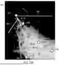 Fig. 49 - METHODS FOR IMPROVED SURGICAL PLANNING USING MACHINE LEARNING AND DEVICES THEREOF