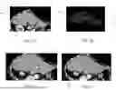 Fig. 14 - SYSTEMS AND METHODS FOR ADAPTIVE ABLATION VOLUME PREDICTION BASED ON TISSUE TEMPERATURE MEASUREMENTS AND ANATOMICAL SEGMENTATION