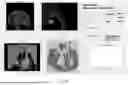 Fig. 17 - SYSTEMS AND METHODS FOR ADAPTIVE ABLATION VOLUME PREDICTION BASED ON TISSUE TEMPERATURE MEASUREMENTS AND ANATOMICAL SEGMENTATION