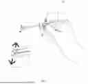 Fig. 03 - TWEEZERS AND A METHOD OF CONDUCTING ROOT CANAL THERAPY