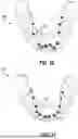 Fig. 13 - DENTAL APPLIANCES AND ASSOCIATED METHODS OF MANUFACTURING