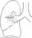 Fig. 01 - Implantable Artificial Bronchus And Use Of An Implantable Artificial Bronchus
