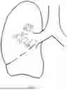 Fig. 05 - Implantable Artificial Bronchus And Use Of An Implantable Artificial Bronchus