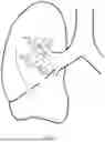 Fig. 06 - Implantable Artificial Bronchus And Use Of An Implantable Artificial Bronchus