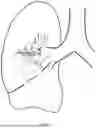 Fig. 08 - Implantable Artificial Bronchus And Use Of An Implantable Artificial Bronchus